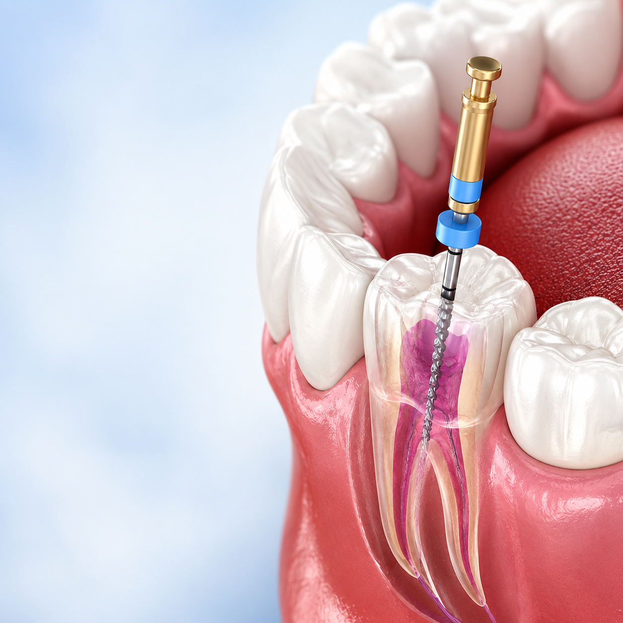 Endodoncia