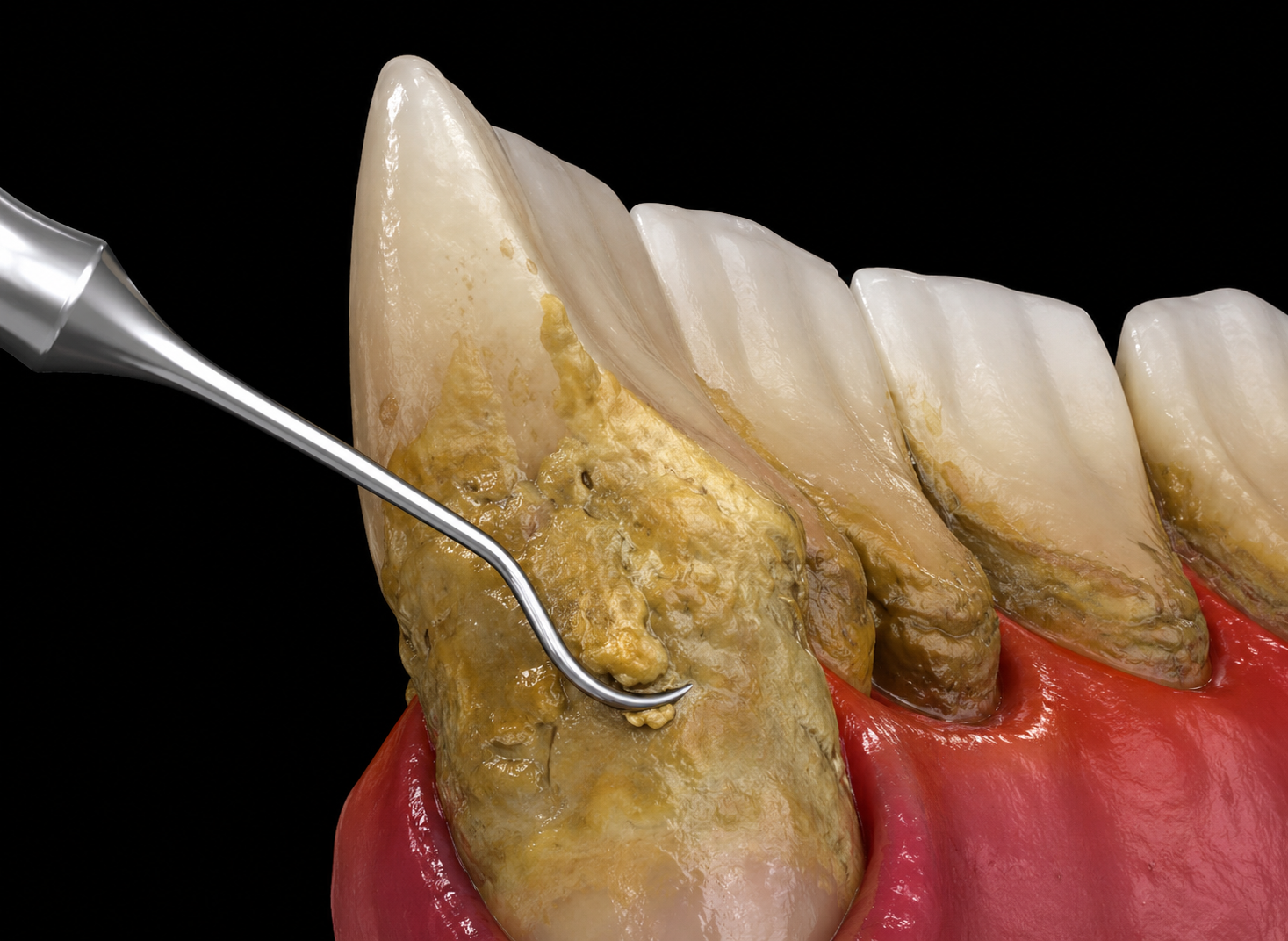 Periodoncia